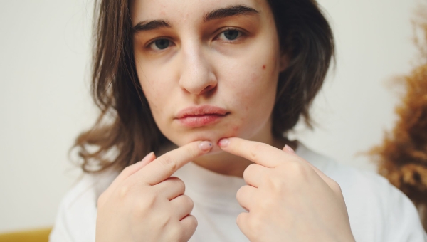 Acné : causes, types et traitements efficaces selon la sévérité 